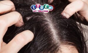 Giải mã giấc mơ: Nằm mơ thấy con chấy đánh con gì dễ ăn?